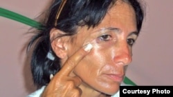 Leticia Ramos Herrería muestra golpes recibidos ayer 3 de noviembre.